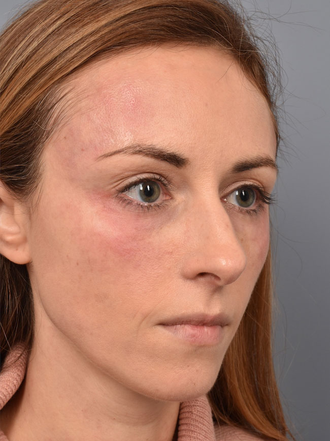 Before laser treatment