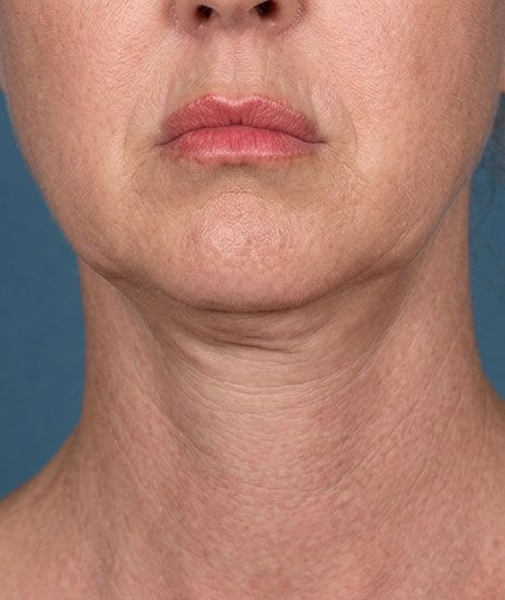Before the Fifth Avenue Lift — jawline and neck